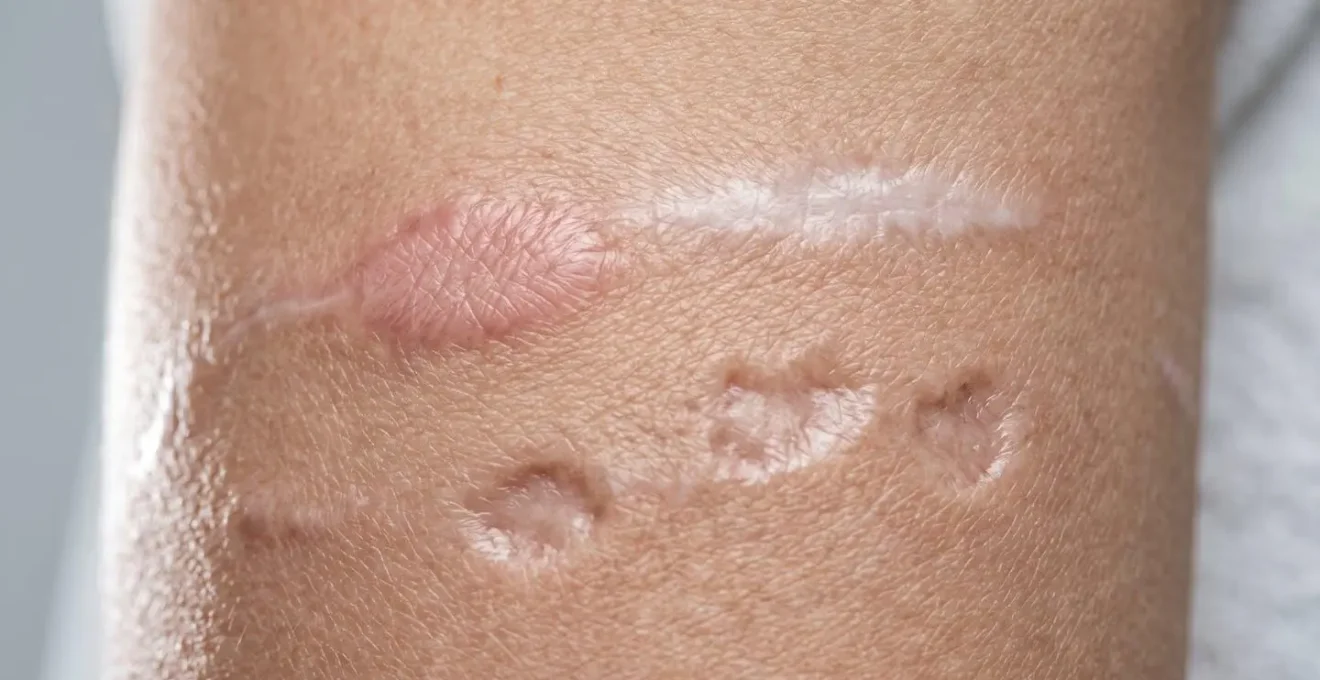 Diversi tipi di cicatrici chirurgiche mostrate su pelle con texture realistiche