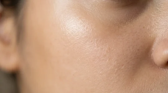 Primo piano di pelle del viso levigata e luminosa con texture uniforme dopo trattamento cicatrici